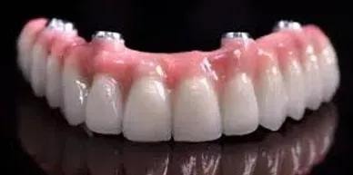 Implant supported denture with metal posts